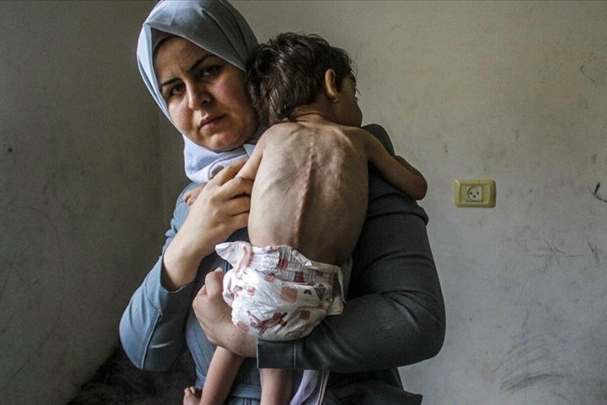 <p>3500 uşaq qida çatışmazlığı səbəbindən ölüm riski altındadır</p>